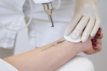 How Much Does Tattoo Removal Cost in Australia?